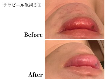 フレイヤ(FREYA)/ララピールBefore→After