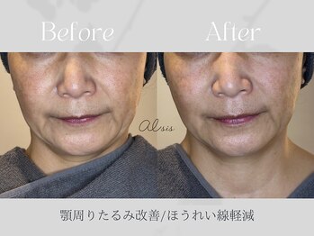 アイシス(AIsis)/【たるみ】LDMハイプレミアム