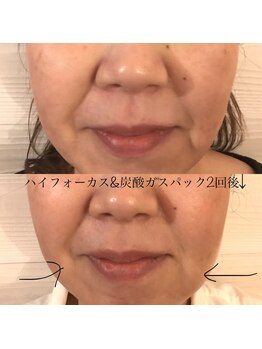 エトル(etole)/40代後半　お客様症例写真