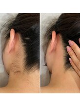 インベスト(INVEST)/うなじ脱毛