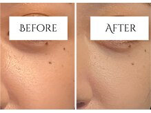 クク 赤坂 天神(99 KUKU)/【ほうれい線】【頬】