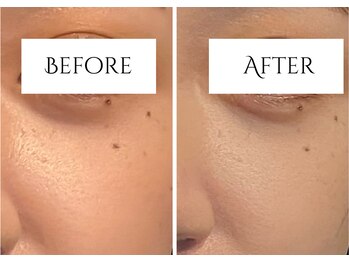 クク 赤坂 天神(99 KUKU)/【ほうれい線】【頬】