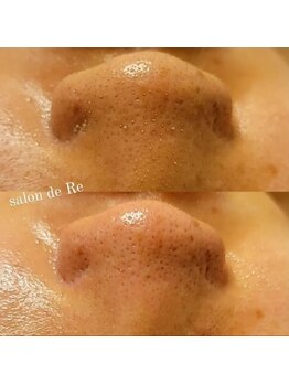 サロンドリー(salon de Re)/超音波エクストラクション