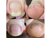 ベルタネイル(BELTA NAIL)