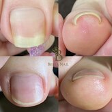 ベルタネイル(BELTA NAIL)