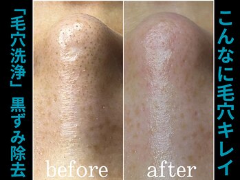 ティーツリー 名古屋 桜山(Tea Tree)/毛穴洗浄でしっかり除去