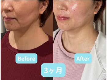 ホープ鍼灸整骨院/10回の施術結果です！