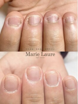 マリーロール 天王寺店(Marie Laure)/自爪育成/深爪矯正/ネイルケア