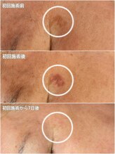 ジン フォー ユアビューティー(JIN for your beauty)/施術経過