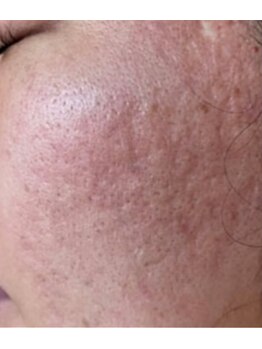 リベル 名古屋(Lebelle:)/ハーブピーリング専門名古屋