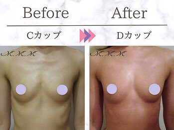 メディカルサロン エム エム エム 銀座プレミアムサロン(M.M.M.)/【バストアップ例】 C→Dカップ