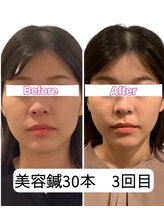 アネモネ 心斎橋院/小顔リフトアップしたい方に