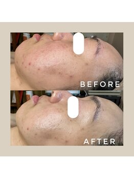 カウニス るる(kaunis)/【ララピール】Before After