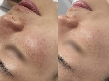 プトゥリチュール(Putritulle)/バクチオールピール