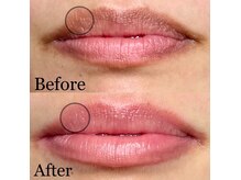 エステティックサロン フェリス(Aesthetic salon FELIZ)の雰囲気（粘膜のくすみ改善！唇・バストトップ・デリケートゾーンに対応◎）