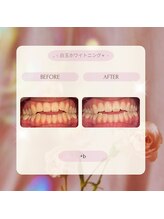 プラスビー 2号店(+b)/ホワイトニングビフォーアフター