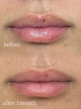 ラミパス(LAMIPAS)/ローマピンク　症例　1ヶ月後