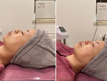 ニコルビューティー 高槻 南平台店(NiKOR beauty)の写真/【クリスマスオススメ♪】冬の美肌ケア♪乾燥と毛穴はセットで改善!ピーリング×毛穴洗浄70分¥7000→¥4900