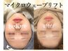 予約殺到中【マイクロウェーブリフト頬+顎下】瞬間小顔&人中短縮 ¥11000