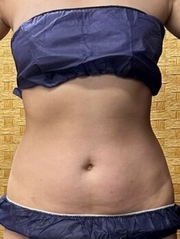 テラスアップ(Terrace UP)の写真/本気でサイズダウンを目指したい方★代謝をアップさせてスリムなボディへ導く集中ケア！限定クーポンあり◎