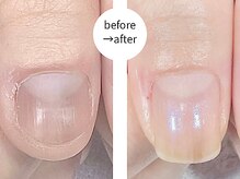 エマ(EMA)/深爪噛み爪でお悩みだったお客様