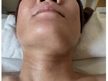 ベニー 不思議とベニー(BENNIE)の雰囲気（サーマトリックス3回でこれだけ変化された方も！5回目で左右対象）