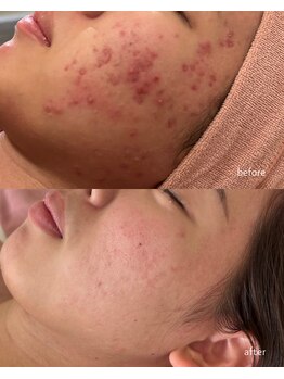 ナンバーナイン(No.9)/ニキビ改善