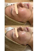 サロンモア(salon More)/ハーブピーリング