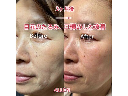 アレン(ALLEN.)の写真