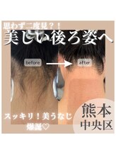アート 熊本並木坂店(ART) うなじ 脱毛