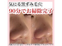 アルムダアクア 天王寺店(Aleumda AQUA)/毛穴エクストラクションプロ