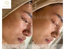 サロンドレナ 名駅店/ハーブピーリング サロンドレナ