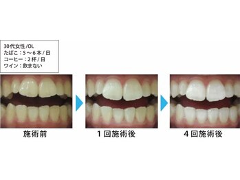 ルミナ(LUMINA)/ホワイトニングでヤニ汚れ撃退!
