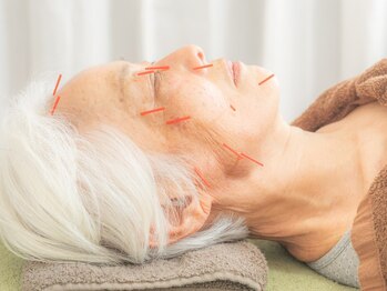 かけこみでらの写真/【本気のたるみケア】美容鍼30本×電気パルスでググッと引き上げ!ほうれい線・むくみも徹底アプローチ◎