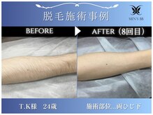 メンズビービー 福井高柳店(MEN'S BB)/ボディ脱毛施術事例