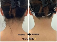 メディカルサロンドオフ 堺東店(medical salon de off)/うなじ襟足脱毛♪