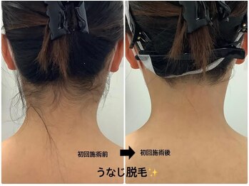 メディカルサロンドオフ 堺東店(medical salon de off)/うなじ襟足脱毛♪