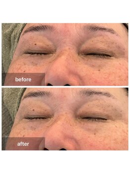 ルミエール(Lumiere)/５０代　くすみむくみ改善