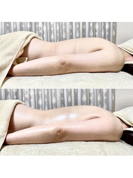 エン ボディアンドフェイシャル(En)/ハイパーナイフ・二の腕引き締め