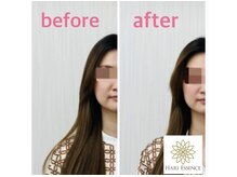 ハリエッセンス(HARI ESSENCE)/美容鍼ビフォーアフター