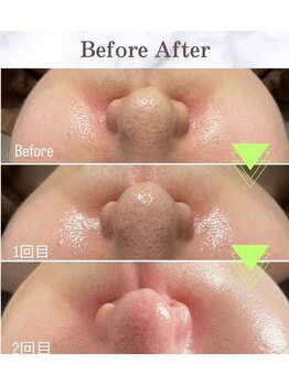 シャンディ(Shandy)/ラミピールで毛穴ケア