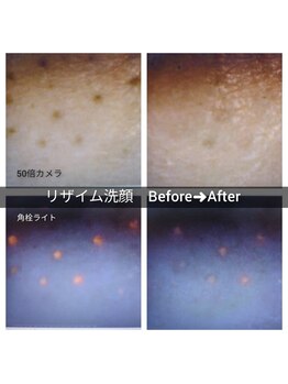 ポアレスサロン フィル(fil)/鼻のリザイム洗顔後結果