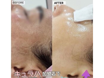 パールブルー(All Perl blue)/韓国白玉美肌ケア6回コース