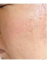 リベル 名古屋(Lebelle:)/ハーブピーリング専門名古屋