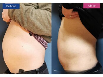 コリオ(KoRiO)/痩身5回目のお客様［狭山ヶ丘］