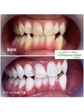 ホワイトニングサロン 名古屋駅店/【ホワイトニング施術例】
