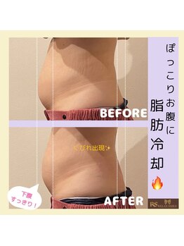 アールアンドエス(R&S)/脂肪冷却