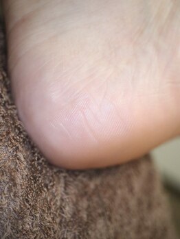 ピサラ(PISAR)/フットケア施術後