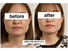 グリーン鍼灸整体院(green鍼灸整体院)/エラ撃退美容鍼