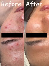 エクリア(ECLIA)/スピキュール+毛穴洗浄